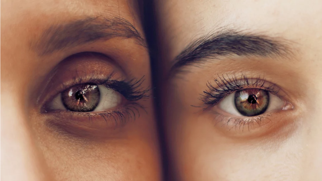 Close-up of eyes with puffiness and under-eye bags
