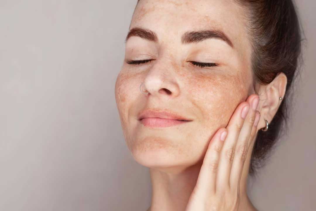 Close-up of woman with dark spots on her skin