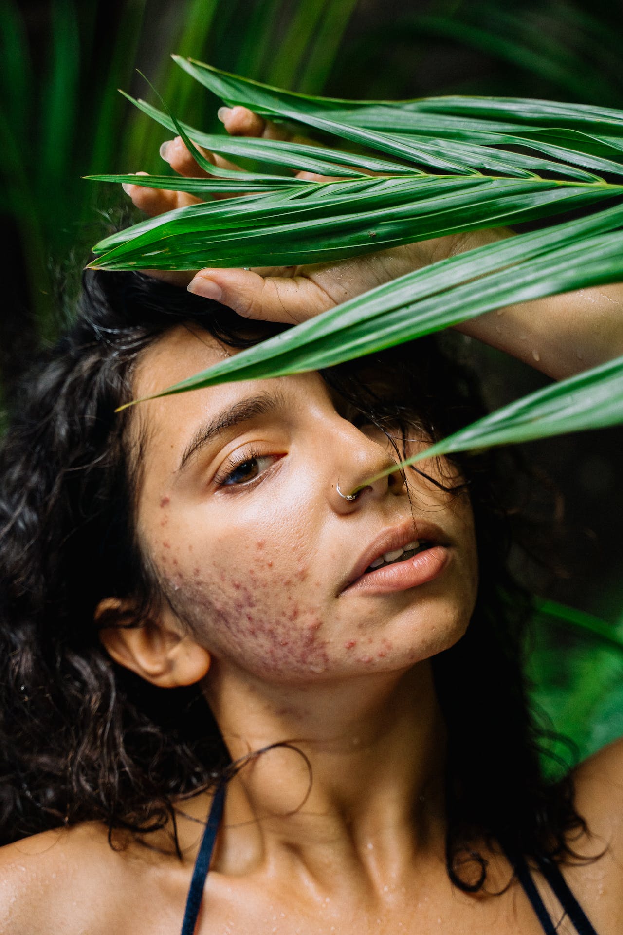 woman with acne standing behind a plant